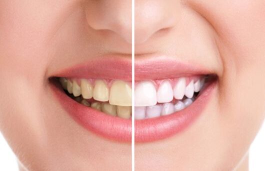 Teeth Whitening